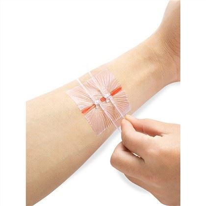 Zip Stitch Wound Skin Closures